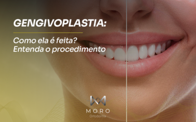 Gengivoplastia: como é feita? Entenda o procedimento | Moro Ortodontia