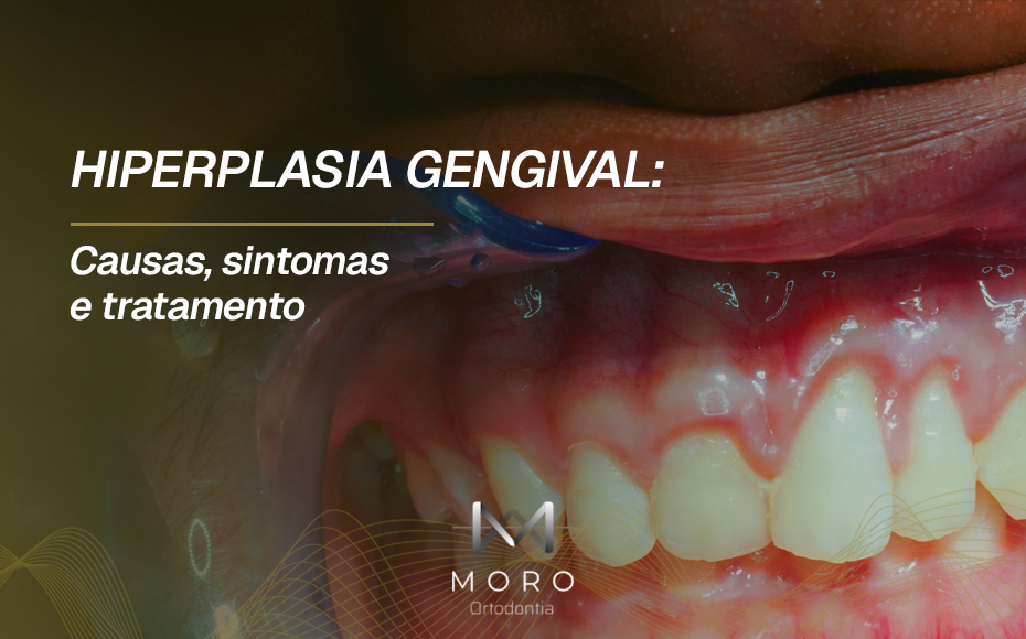 Hiperplasia gengival: causas, sintomas e tratamento