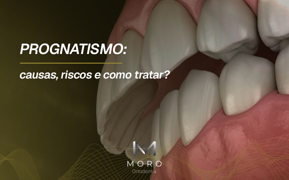Prognatismo: causas, riscos e como tratar?