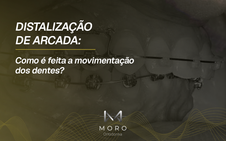Distalização de arcada: como é feita a movimentação dos dentes?